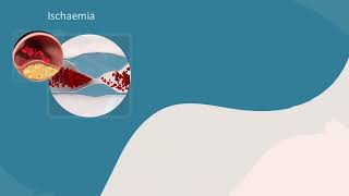 Systemic thromboembolism [upl. by Ecnahoy]