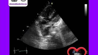 Tetralogy of Fallot [upl. by Llerahs762]