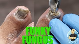 HAVE NAIL FUNGUS YOU NEED TO BE DOING THIS SUPER IMPORTANT TIP [upl. by Garin]