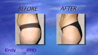 ENDYMED 3Deep Skin Tightening amp Body Contouring  Austin Dermatology [upl. by Crosby944]