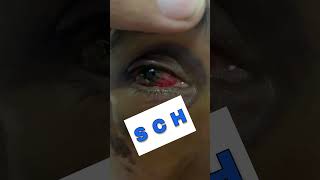 Subconjunctival Hemorrhage Part 4 Shorts SubconjunctivalHemorrhage [upl. by Edualc]