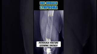 NonHodgkin lymphoma shorts bones health [upl. by Elconin980]