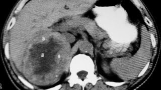 CAR  Case of the week  Case 15  Adrenal hemangioma [upl. by Ahseiuqal]