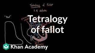 Tetralogy of fallot  Circulatory System and Disease  NCLEXRN  Khan Academy [upl. by Tsan]