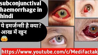 subconjunctival haemorrhage in hindi ये आपातकालीन इमर्जन्सी है क्या अांख के निचे खुन जमा होना [upl. by Morna]