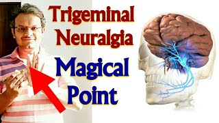 Acupressure Points For TRIGEMINAL NEURALGIA Acupressure For Trigeminal Neuralgia MADE EASY  HINDI [upl. by Balfour378]