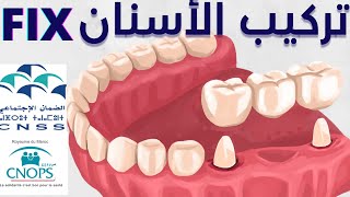 🦷 CNOPS CNSS كل ما يخص تركيب الأسنان الفيكس [upl. by Cullan607]