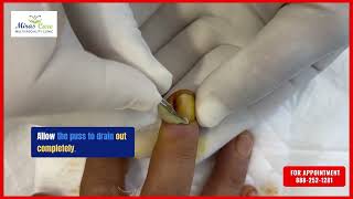 Paronychia fingernail abscess infection treatment  Fingernail Abscess Removal in Gurgaon [upl. by Christianity]