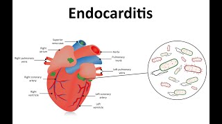 Differential Diagnosis For Infective Endocarditis [upl. by Siuol]