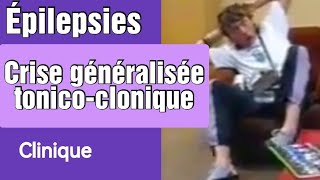 Les crises tonicocloniques généralisées en direct [upl. by Giulietta]