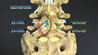 Medical Animation of Lumbar Stenosis Decompression [upl. by Essyle]