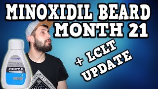 Minoxidil Beard Growth Results  LCLT UPDATE  Month 21  TheJourneyContinues [upl. by Rochella341]