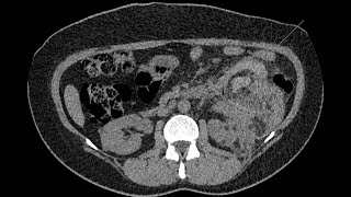 Hemorrhagic renal angiomyolipoma in a tuberous sclerosis phakomatosis patient [upl. by Nottnerb]