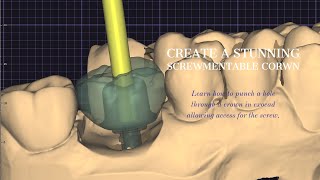 Ultimate Tutorial Screw Retained Implant Crown in Exocad  Step by Step Guide [upl. by Dnesnwot608]