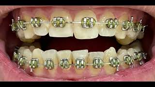 DENTAL JOURNEY  How my Face Changed with Braces Composite Bonding amp Whitening [upl. by Barnes254]