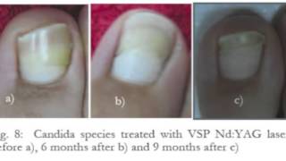 Mycose des ongles traitée au laser [upl. by Fredela]