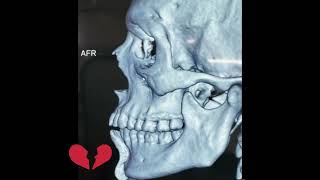 Para symphysis fracture and its treatment plan facial trauma mandible facialmask [upl. by Aihcsrop]