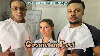 Cosmelan Peel Full Demo  closer look at the most important first 2 weeks after the peel 2022 [upl. by Yentruok]