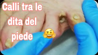 Calli dolorosi tra le dita del piede 🤕callipiede armoniadonna catania [upl. by Aicre758]