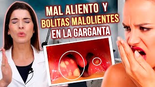 ELIMINA las Bolitas Malolientes de la Garganta y el MAL ALIENTO [upl. by Isa]