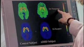 Brain imaging gives new insight into underlying cause of ADHD [upl. by Allicsirp]