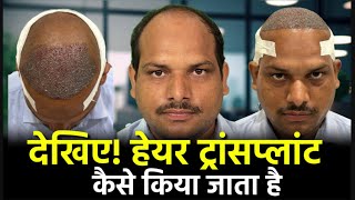 Hair Transplant In Bhopal [upl. by Ainotna]