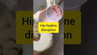 Hip Joint Cartilage Disruption Model [upl. by Ingemar]