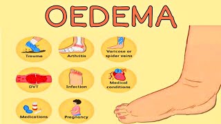 OEDEMA  TYPE OF OEDEMA  OEDEMAS CAUSES [upl. by Swehttam]