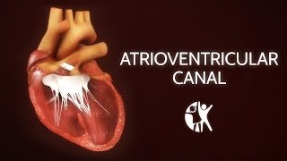 Atrioventricular Septal Defect  AV Canal [upl. by Niwdla]