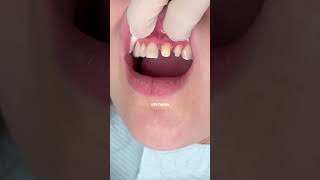 Porcelain crowns front teeth  natural porcelain crown  Dr Yazdan  porcelain crown procedure [upl. by Egor625]