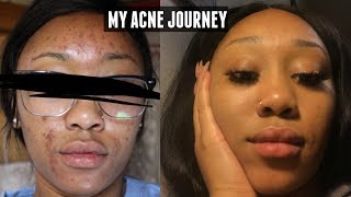 MY ACCUTANE EXPERIENCE  Before and After Pics Products Used Side Effects [upl. by Terza834]