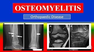 OSTEOMYELITIS  Definition types causes pathophysiology signs amp symptoms medicine [upl. by Sonja]