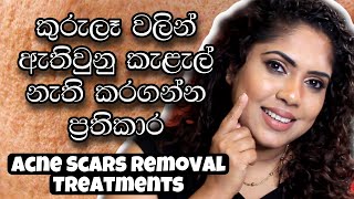 TREATMENTS FOR ACNE SCARS  ALL ABOUT ACNE SCARS  SINHALA BEAUTY TIPS 2021 [upl. by Rush]