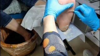 Pedicure  Dead skin removal and Cracked heels treatment by Professional technician [upl. by Elephus737]