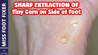 How To Remove TINY CORNS From Foot  Foot Side Tiny Corns Removal 2022  By Miss Foot Fixer [upl. by Atiluj696]