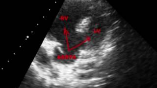 TETRALOGY OF FALLOT TOF  ECHOCARDIOGRAPHY SERIES BY DR ANKUR K CHAUDHARI [upl. by Netsriik]