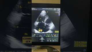 Cor Pulmonale on 2D echo cardio echo heart [upl. by Asserak]