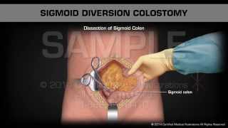 Sigmoid Diversion Colostomy [upl. by Alecram36]