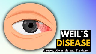 Weils Disease Causes Symptoms And Treatment [upl. by Aicilef175]