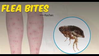 Flea Bites Everything you Need to Know [upl. by Atil283]