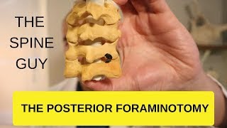 CERVICAL STENOSIS RADICULOPATHY  PART 4  THE POSTERIOR FORAMINOTOMY [upl. by Eustis]