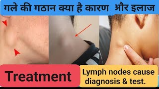 गले की गांठ क्या है कारणजांचइलाजlymph nodesneck nodes treatment cause diagnosistest [upl. by Sholley]