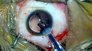 Posterior polar cataract phaco [upl. by Hbaruas]