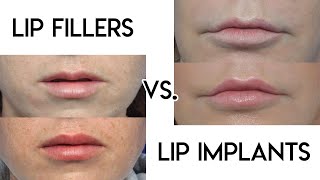 Permalip Lip Augmentation with Silicone Lip Implants Part 1 by Seattle Bellevues DrYoung [upl. by Dorey792]