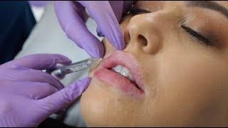 Lip Fillers  what to expect during the procedure  The Laser amp Skin Clinic [upl. by Wiseman]