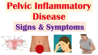 Pelvic Inflammatory Disease PID Signs amp Symptoms amp Why They Occur [upl. by Veno284]