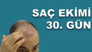 Saç ekimi  Şok dükülme 30 gün [upl. by Sisco]