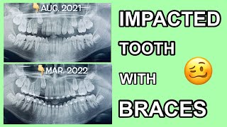 Before and After Braces at The Orthodontic Centre Palmerston North [upl. by Atiuqram]