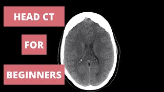 How to Read a Head CT  Radiology Approach [upl. by Barney]