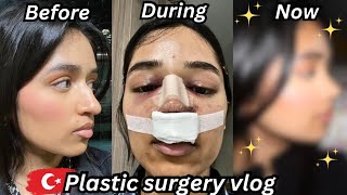 i got a rhinoplasty in TURKEY amp documented my entire recovery nose job vlog [upl. by Panayiotis952]